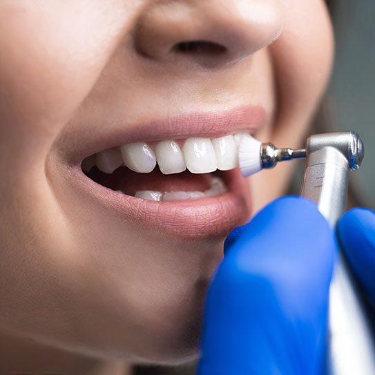 The Ultimate Guide to Protecting Your Smile: Why Routine Dental Cleanings Matter - Euclid Dental Center - dentist in ontario,dental cleanings dentist in ontario dental cleanings